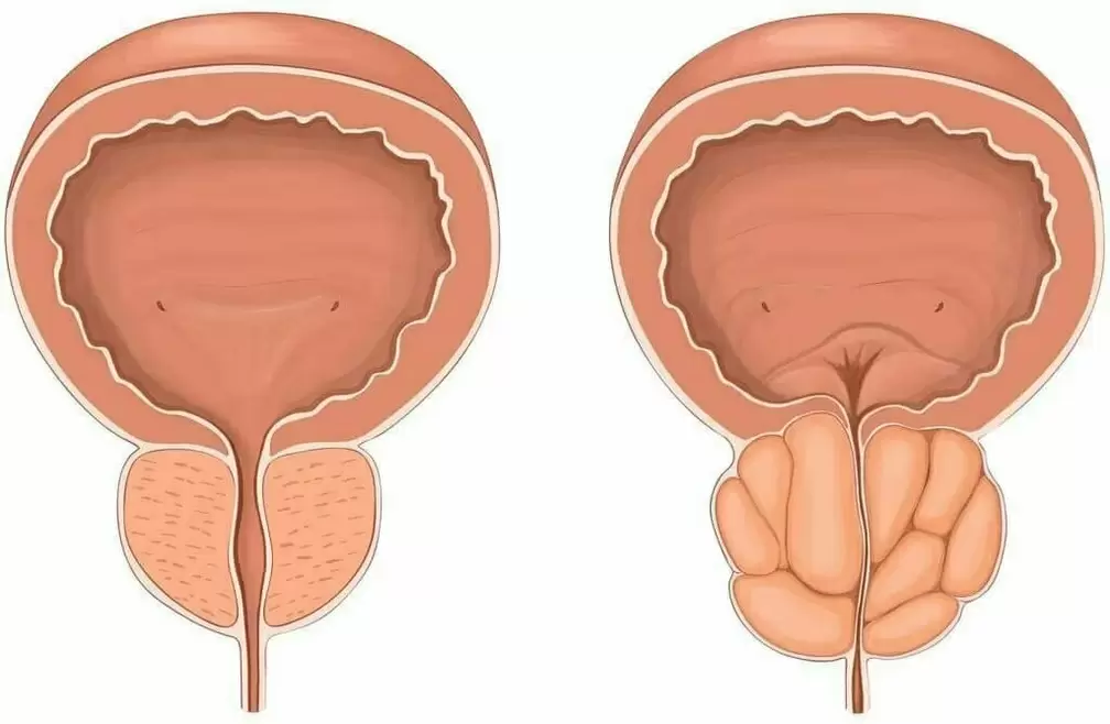 normal prostate and diseased prostate
