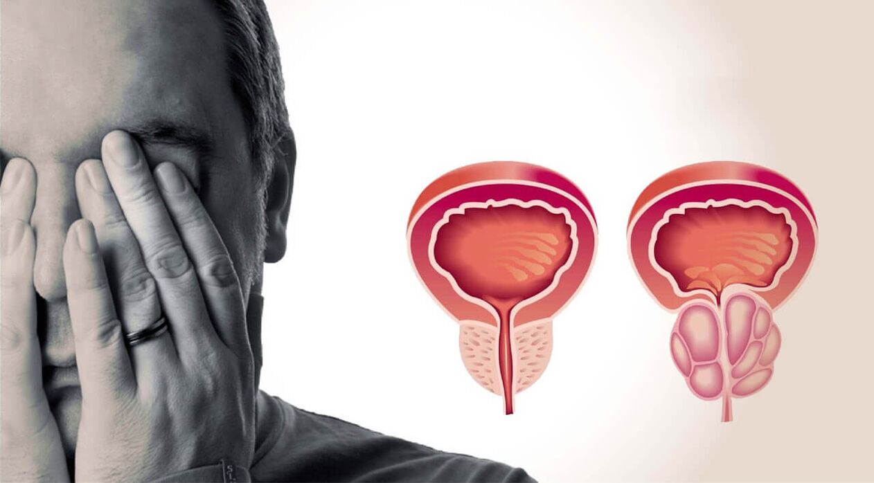 healthy and diseased prostate in men