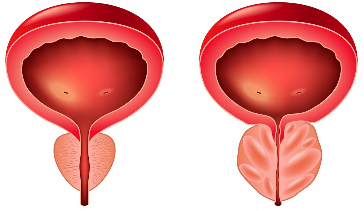 difference between prostate glands